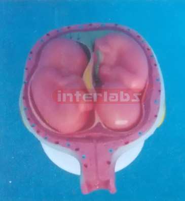 UTERUS WITH EMBRYO TWINS (5 MONTH)